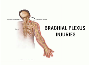 Brachial Plexus Injuries